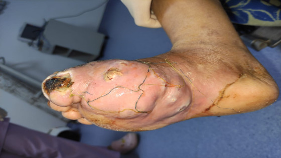 طانطان: نجاح اول عملية جراحية لسيدة كانت تعاني من Pied diabetique délabré avec perte de substance